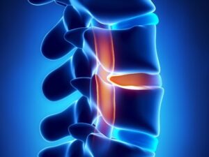 Spinal Cord Injury Attorney